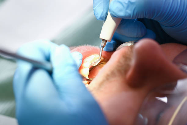 Best Emergency Treatment for Dental Infections or Abscesses in Longview, WA